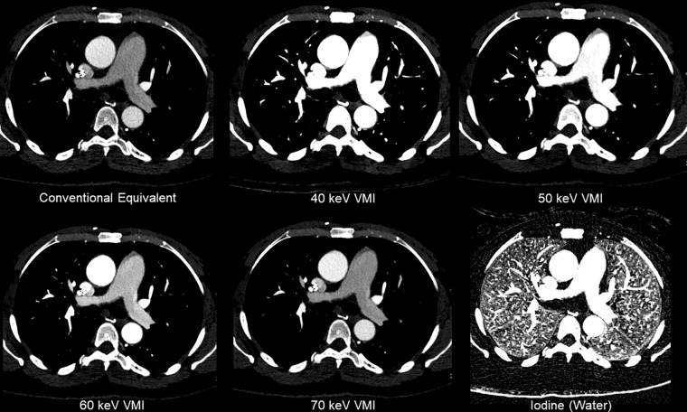 Effects of multienergy CT reconstruction on contrast media attenuation. Pulmonary CT angiogram obtained on a dual-layer spectral scanner shows suboptimal opacification of the pulmonary arteries on conventional-equivalent image reconstruction (window settings: center = 250 HU; width = 500 HU). Series of virtual monoenergetic images (VMI) reconstructed from 40 keV through 70 keV, displayed with similar window settings to the conventional-equivalent image, show increased signal of iodinated contrast material. Images reconstructed with 50 keV or less were deemed adequate for interpretation. Dual-material decomposition with iodine and water [“Iodine (Water)”] can be used to improve visualization of intravascular contrast and allow for visualization of lung perfusion.