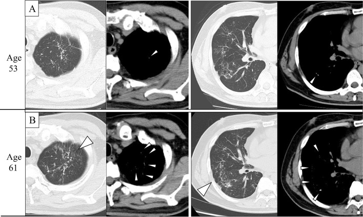 Dendriform Pulmonary Ossification: Findings from Eight Years of ...