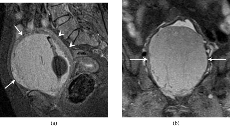 Imaging Findings Of A Primary Bladder Maltoma Pmc