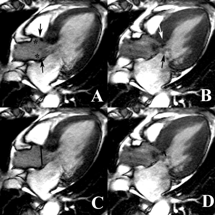 Cardiac MRI evaluation of hypertrophic cardiomyopathy: Left ventricular ...