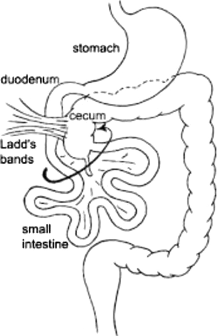 Ladd’s band in the adult, an unusual case of occlusion: Case report and ...