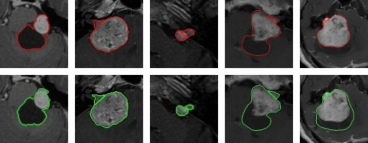 Examples of cystic, large, and small vestibular schwannoma whole tumor annotations, including the separation between the intra- and extrameatal tumor parts, of contrast-enhanced T1-weighted MRI scans. The top row shows the convolutional neural network (CNN) predictions in red, and the bottom row shows the delineation of annotator 1 in green. The first, fourth, and fifth tumors are potentially hard to delineate for the CNN because of the large peripheral cystic tumor parts. The Dice scores of these patients were 0.96, 0.96, 0.91, 0.93, and 0.72, respectively, and the surface-to-surface distances were 0.39 mm, 0.21 mm, 0.24 mm, 0.35 mm, and 3.44 mm, respectively.