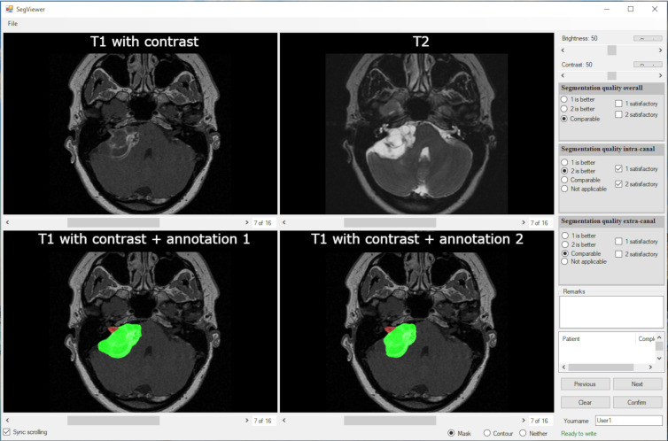 Observer study interface. The top row shows the clean, gadolinium-enhanced T1-weighted MRI and T2-weighted MRI scans. The bottom row shows the convolutional neural network and human annotations, randomized to the left and the right pane, respectively. The multiple-choice questions for each observer are shown at the right side of the interface. The observers could also add free-text comments.