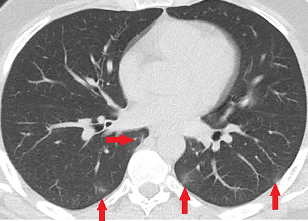 Unenhanced CT of the chest of a 43-year-old man with confirmed COVID-19 pneumonia. Few small peripheral patchy ground-glass opacities (arrows) are the only positive findings on the chest CT of this patient.