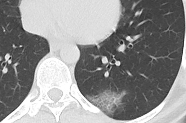 Unenhanced CT of the chest of a 62-year-old woman with confirmed COVID-19 pneumonia shows patchy ground-glass opacity with thickened intralobular septa, creating typical crazy paving appearance.