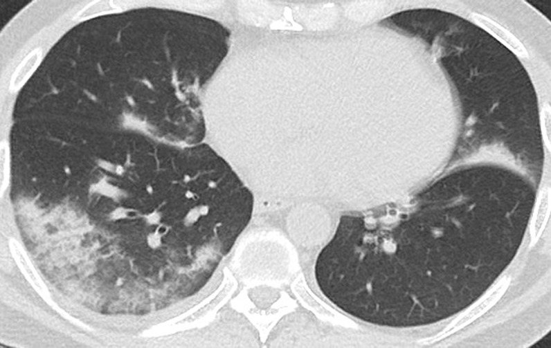 Unenhanced CT of the chest of a 53-year-old man with confirmed COVID-19 pneumonia who was admitted to the intensive care unit and intubated. (a) Lung window shows bilateral mixed consolidation and ground-glass opacities. (b) Mediastinal window at the same level shows minimal pleural effusion on the right side (arrow).