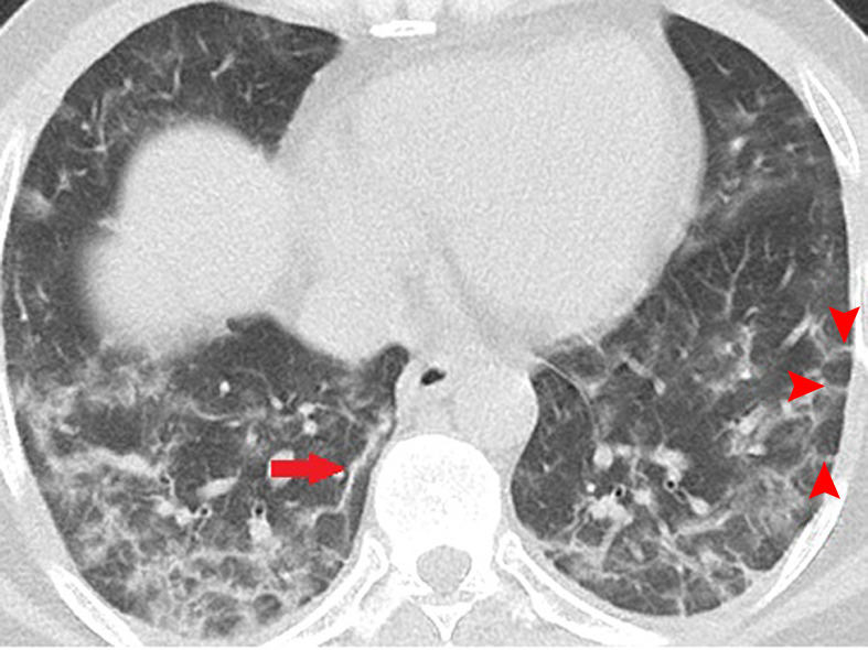 Unenhanced CT of the chest of two patients with confirmed COVID-19 pneumonia. (a, b) Multiple bilateral linear and reticular opacities (arrows) in a 50-year-old man. Note the linear opacities with an arc pattern (arrowheads) on the left side, representing perilobular opacities, called perilobular sign which is a typical sign of organizing pneumonia. Note some of the mentioned opacities on b outline borders of secondary pulmonary lobules (arrowheads), representing interstitial pneumonia. (c) A peripheral linear consolidation (arrow) in the left lung as well as ground-glass opacities and consolidations in some other parts of both lungs in an 81-year-old woman.