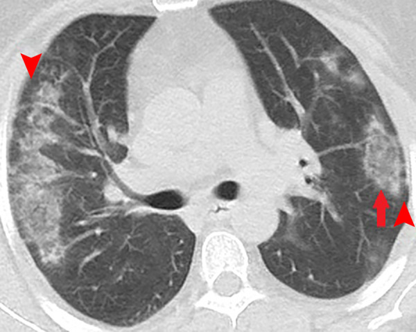 Unenhanced CT of the chest of a 53-year-old woman with confirmed COVID-19 pneumonia. Bilateral peripheral patchy mixed consolidation and ground-glass opacities are shown, with areas of subpleural sparing (arrowheads). Note the classic reverse halo sign on the left side (arrow).