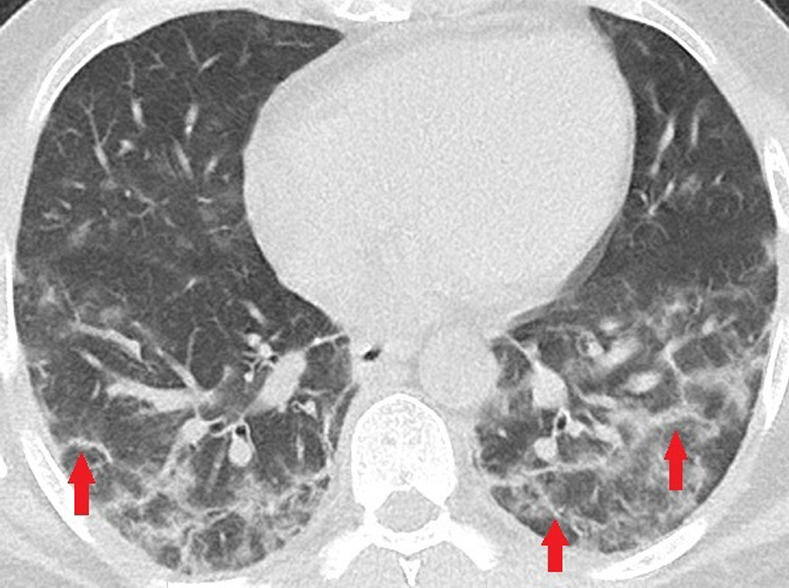 Unenhanced CT of the chest of two patients with confirmed COVID-19 pneumonia. (a, b) Multiple bilateral linear and reticular opacities (arrows) in a 50-year-old man. Note the linear opacities with an arc pattern (arrowheads) on the left side, representing perilobular opacities, called perilobular sign which is a typical sign of organizing pneumonia. Note some of the mentioned opacities on b outline borders of secondary pulmonary lobules (arrowheads), representing interstitial pneumonia. (c) A peripheral linear consolidation (arrow) in the left lung as well as ground-glass opacities and consolidations in some other parts of both lungs in an 81-year-old woman.