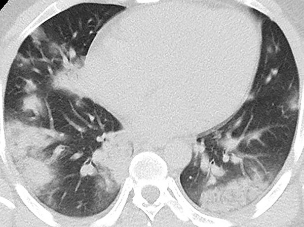 Unenhanced CT of the chest of a 28-year-old man with confirmed COVID-19 pneumonia. Multiple peripheral consolidations are shown bilaterally, with patchy and segmental morphology.