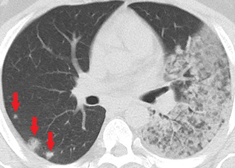 Unenhanced CT of the chest of a 32-year-old man who died because of confirmed COVID-19 pneumonia. (a, b) Multiple consolidations with nodular/round configuration in the right lung at two different levels. Note the extensive mixed consolidation and ground-glass opacities in the left lung.