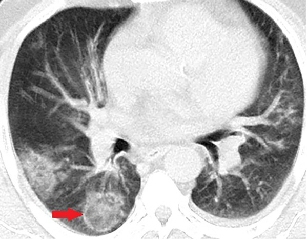 Unenhanced CT of the chest of a 56-year-old man with confirmed COVID-19 pneumonia. Typical reverse halo sign is seen in the right lower lobe (arrow).