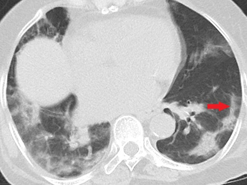 Unenhanced CT of the chest of two patients with confirmed COVID-19 pneumonia. (a, b) Multiple bilateral linear and reticular opacities (arrows) in a 50-year-old man. Note the linear opacities with an arc pattern (arrowheads) on the left side, representing perilobular opacities, called perilobular sign which is a typical sign of organizing pneumonia. Note some of the mentioned opacities on b outline borders of secondary pulmonary lobules (arrowheads), representing interstitial pneumonia. (c) A peripheral linear consolidation (arrow) in the left lung as well as ground-glass opacities and consolidations in some other parts of both lungs in an 81-year-old woman.