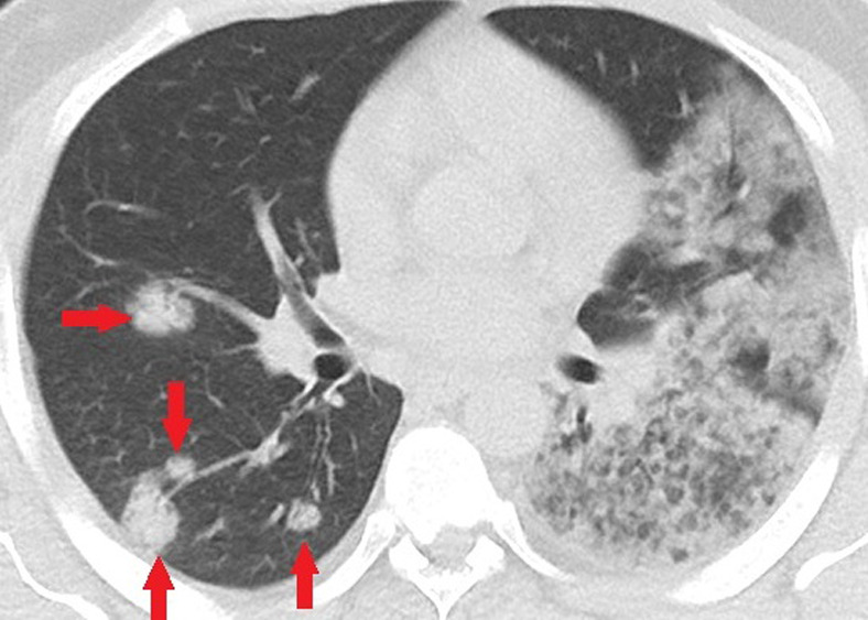 Unenhanced CT of the chest of a 32-year-old man who died because of confirmed COVID-19 pneumonia. (a, b) Multiple consolidations with nodular/round configuration in the right lung at two different levels. Note the extensive mixed consolidation and ground-glass opacities in the left lung.