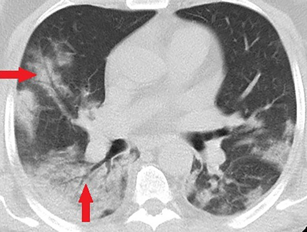 Unenhanced CT of the chest of a 58-year-old man with confirmed COVID-19 pneumonia who was admitted to the intensive care unit and intubated. Bilateral mixed consolidation and ground-glass opacities are shown, with an air bronchogram appearance (arrows) on the right side.