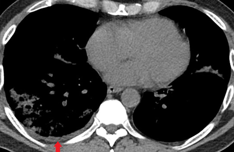 Unenhanced CT of the chest of a 53-year-old man with confirmed COVID-19 pneumonia who was admitted to the intensive care unit and intubated. (a) Lung window shows bilateral mixed consolidation and ground-glass opacities. (b) Mediastinal window at the same level shows minimal pleural effusion on the right side (arrow).