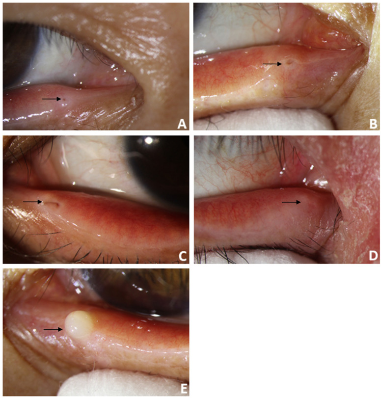 Imaging and anatomical parameters of the lacrimal punctum and vertical ...