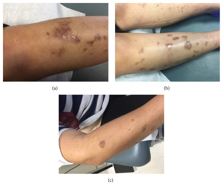 Skin Findings in a Patient with Sjogren's Syndrome - PMC