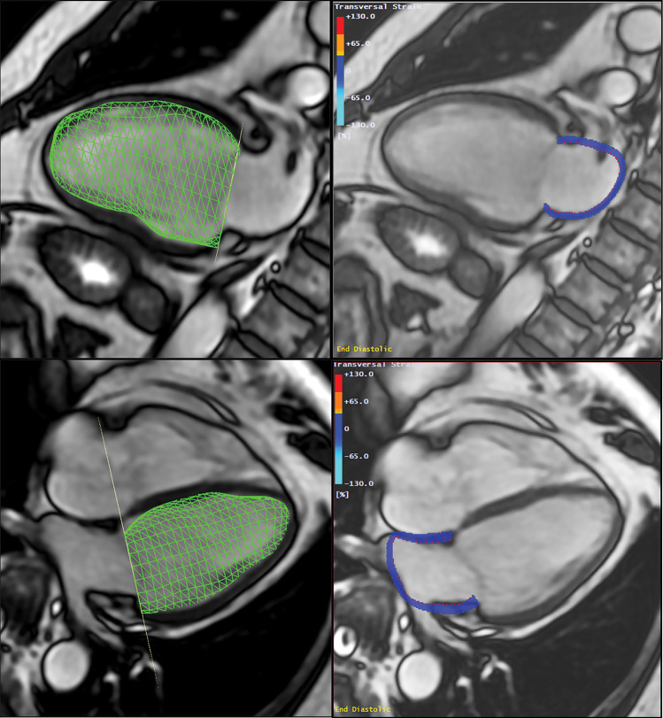 Method to assess the left atrioventricular coupling index (LACI) at cardiac MRI. LACI was defined by the ratio between the left atrial (LA) end-diastolic volume and the left ventricular (LV) end-diastolic volume. A stack of short-axis noncontrast cine MRI scans were acquired to encompass both ventricles, and LV end-diastolic volume was measured by using cardiac image modeler software (green volume, left panel). LA end-diastolic volume was measured by using multimodality tissue-tracking software to track LA wall motion during the end-diastole in the four-chamber and two-chamber views (pink borders, right panel).