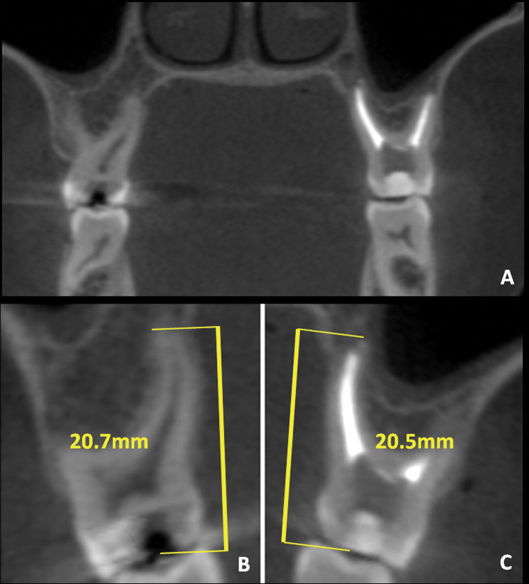 Figure 1. Coronal view of contralateral upper molars (A). Vital (B) and filled (C) tooth measurements.