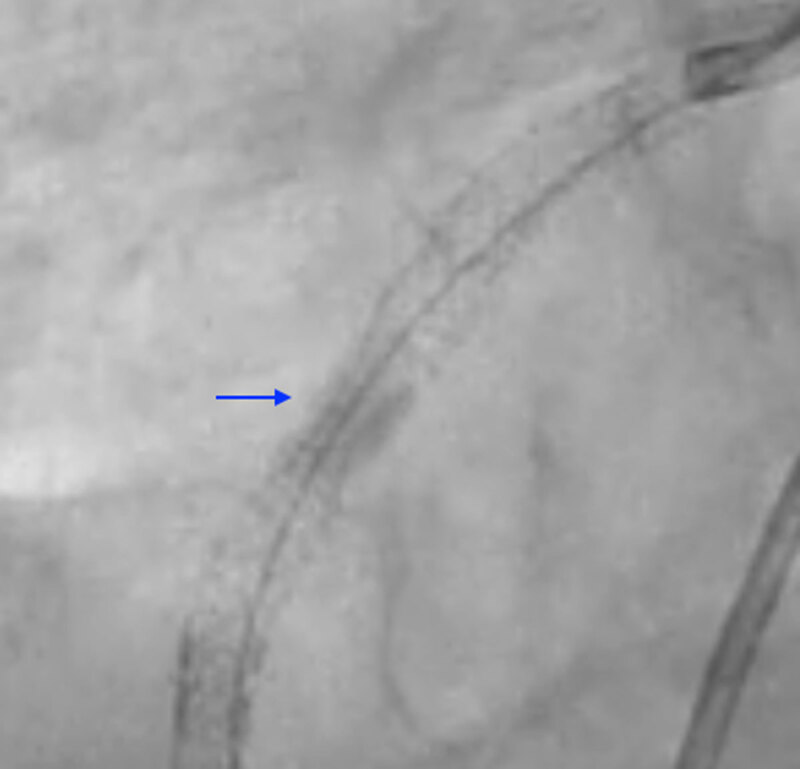 Dry-cine of RCA stent pre-IV lithotripsy