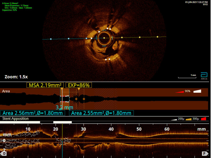 OCT of RCA shows calcification with under-expanded and malapposed stent