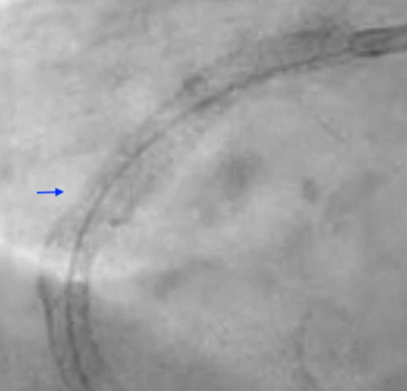 Dry-cine of RCA stent post-IV lithotripsy reveals stent-release