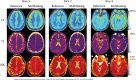 Representative in vivo T1, T2, and apparent diffusion coefficient
(ADC) mapping of three sections with use of multitasking and the respective
reference protocols in a healthy volunteer. Multitasking provides T1, T2,
and ADC maps with good qualitative agreement with the references and without
image distortion (white arrows), which can be observed on single‐shot
echoplanar imaging ADC maps. (Reprinted, with permission, from reference
7.)