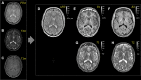 Multiparametric quantitative MRI (MP-qMRI) example with the triple turbo
spin-echo pulse sequence. Same-section directly acquired images and quantitative
MRI parameter maps in the axial plane. The left column shows the three images
directly acquired with (A) proton density weighting (PDw), (B) T2 weighting
(T2w), and (C) T1 weighting (T1w). The insert on the right shows the
same-section MP-qMRI maps: (D) the cerebrospinal fluid–normalized proton
density map (nPD) and (E, F) relaxation rate maps. Note that the inverse white
matter (WM)–to–gray matter contrast in the relaxation rate maps
versus (G, H) the relaxation time maps, in which WM is not only brighter but
also shows marked texture. Furthermore, the WM texture of the longitudinal
relaxation rate (R1) map is different from that in the transverse relaxation
rate (R2) map. All images are in a 35-year-old healthy male volunteer and were
acquired with the 9-minute scan (80 contiguous sections; reconstructed voxel =
0.5 × 0.5 × 2 mm) used for the ELGAN-ECHO (Extremely Low
Gestational Age Newborns–Environmental influences on Child Health
Outcomes) study (103).
