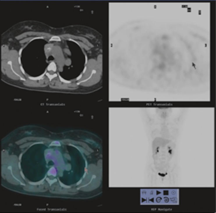 Fibrosing Mediastinitis: An Unusual Cause of Pulmonary Symptoms - PMC