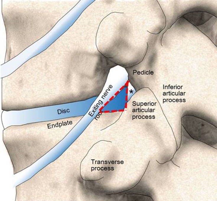 Ultrasound-Guided Lumbar Intradiscal Injection for Discogenic Pain ...