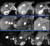 (A, B) Axial abdominal MRI scans in a 65-year-old female patient with
hepatitis C–induced cirrhosis decompensated by hepatocellular
carcinoma show (A) an arterially enhancing lesion with portal venous washout
with (B) pseudocapsule appearance consistent with Liver Imaging Reporting
and Data System 5 lesion larger than 3.0 cm in segment IVb (arrows).
(C–E) After the patient underwent conventional transarterial
chemoembolization (with ethiodized oil) of this lesion, axial sections from
a subsequent MRI examination demonstrate (C) involution of the lesion, along
with lack of enhancement (arrow) indicative of no residual tumor; however,
(D) a new arterially enhancing lesion with (E) restricted diffusion smaller
than 0.3 cm was discovered, concerning for recurrent viable tumor (arrows).
(F) Axial CT image shows gas formation during active hyperthermal ablation
at the distal end of the probe (arrow) when the patient underwent CT-guided
microwave ablation. (G–I) Axial sections from a subsequent MRI
examination demonstrate lack of enhancement within the ablation zone.
Notably, the presence of postprocedural hemorrhagic products at noncontrast
T1-weighted MRI (not shown) make it critical to confirm on enhancement
subtraction images that any signal on the (G) contrast-enhanced MRI scan is
attributable to true enhancement within the ablation zone (arrow), which
could reflect recurrence. Further follow-up images show (H) a new large
central arterially enhancing lesion (arrow) with (I) washout overlying the
portal vein (arrow), consistent with tumor-in-vein or macrovascular
invasion, a poor prognostic indicator requiring the patient to undergo
atezolizumab and bevacizumab. The patient eventually died of ascending
cholangitis complicated by Klebsiella bacteremia likely attributable to
biliary obstruction.