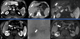 (A) Contrast-enhanced abdominal MRI scan in a 72-year-old male patient
with hepatitis C and alcohol-induced cirrhosis shows two arterially
enhancing lesions (arrows) on axial section with portal venous washout (not
shown), concordant with Liver Imaging Reporting and Data System 5 (LR 5)
lesions smaller than 3.0 cm. (B) Axial CT image acquired during CT-guided
microwave ablation shows the ablation probes positioned within the tumors
(arrows). (C) Follow-up axial abdominal MRI scan demonstrates absence of
enhancement within the ablation zone (arrows) consistent with nonviable
tumor; (D) however, surveillance MRI scan shows that the patient developed
two new arterially enhancing lesions (arrows) with portal venous washout
(not shown) larger than 3.0 cm, both indicative of LR 5 lesions. The patient
underwent transarterial chemoembolization of both new lesions, with (E)
transcatheter subtraction angiogram demonstrating arterial blush of the
tumor in comparison with the liver background (arrow). (F) Subsequent
abdominal axial MRI scan demonstrates absence of enhancement within the
tumor (arrows), indicative of nonviable tumor. The patient eventually
developed additional lesions requiring initiation of bevacizumab and
atezolizumab. The patient’s disease remained stable up until his
death, likely from sequelae of decompensated cirrhosis.