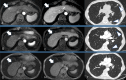 (A, B) Baseline axial abdominal MRI scans in a 76-year-old male
patient with hepatitis C–induced cirrhosis complicated by
hepatocellular carcinoma show (A) an arterially enhancing lesion in segment
VIII (arrow), with (B) washout and pseudocapsule on portal venous phase
image (arrow) consistent with a Liver Imaging Reporting and Data System 5
(LR 5) lesion. (C) Axial chest CT image shows pulmonary nodules concerning
for metastatic disease (arrowheads). The patient underwent systemic therapy
with atezolizumab and bevacizumab. The patient’s initial LR 5 lesion
(arrows) decreased in size and degree of enhancement over the course of (D,
E, G, H) two subsequent surveillance abdominal MRI examinations. (F, I)
Tandem surveillance chest CT examinations demonstrate resolution of the
patient’s initial pulmonary nodules (arrowheads). (Findings are
consistent with partial response as per immune Response Evaluation Criteria
in Solid Tumors.)