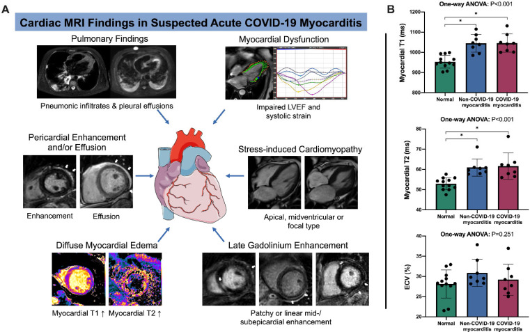 Summary of study results. (a) Composition of imaging findings found in our study cohort. Besides signs of active pulmonary coronavirus disease 2019 (COVID- 19) infection with pneumonic infiltrates and pleural effusions, participants with suspected acute COVID-19 associated myocarditis had an impaired left ventricular function, also with patterns of stress-induced cardiomyopathy in single cases (a midventricular type of stress-induced cardiomyopathy with corresponding diastolic and systolic images is shown). As a key finding a distinct diffuse myocardial edema (detected with myocardial T1 and T2 mapping) was present in most participants. Late gadolinium enhancement lesions (white arrows) were less pronounced, especially when compared to participants with non-COVID-19 myocarditis. Late gadolinium enhancement lesions were present in the subepicardium of the lateral wall or in the basal septal midmyocardium. Some participants displayed pericardial enhancement or small pericardial effusions (see white arrows on corresponding images). All image examples are from the described study cohort of participants. (b) Column graphs with individual plotted values show distribution of quantitative myocardial MRI parameters in healthy participants and in participants with suspected acute non-COVID-19 and COVID-19 myocarditis. Distributions are given for native myocardial T1 relaxation time, myocardial T2 relaxation time, and extracellular volume fraction. Data are presented as mean with standard deviation error bars. The figure contains a free medical image from Servier (https://smart.servier.com/). * indicates significant pairwise comparison (P < .05). LVEF = left ventricular ejection fraction; ANOVA = analysis of variance; ECV = extracellular volume fraction.