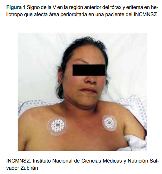 Figura 1 Signo de la V en la región anterior del tórax y eritema en heliotropo que afecta área periorbitaria en una paciente del INCMNSZ