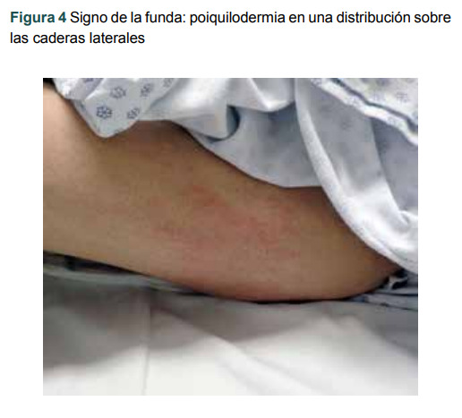 Figura 4 Signo de la funda: poiquilodermia en una distribución sobre las caderas laterales