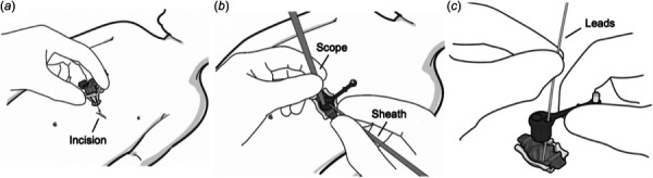 PeriPath procedure workflow overview. (a) Inserting the PeriPath device into the incision. (b) Utilizing the access ports of the PeriPath device. (c) Removing the core of the device.