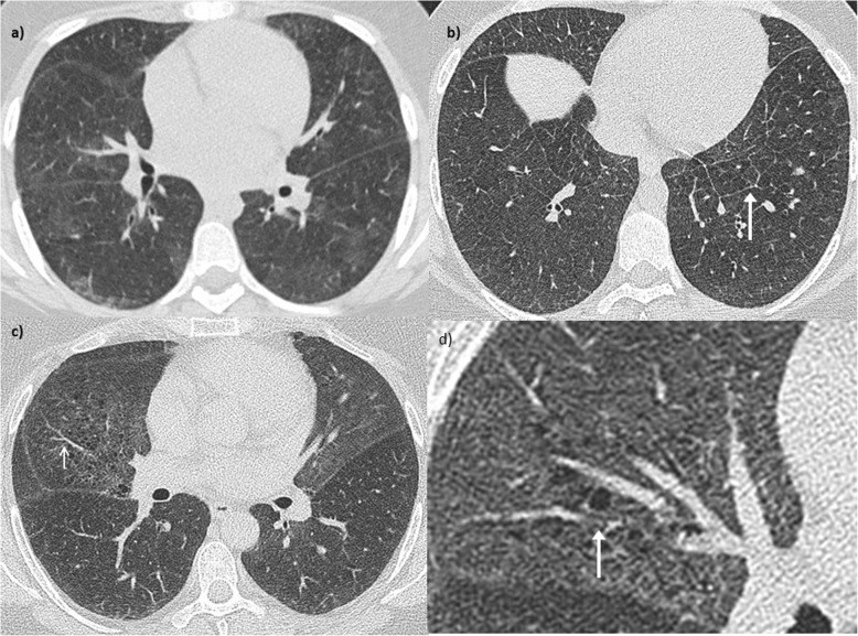 Diffuse Alveolar Haemorrhage Associated With Subsequent Development Of 