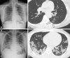 Representative cases show pneumonia extents and patterns with chest
radiographs and CT images during the Omicron period. (A, B) Images in a
52-year-old woman with a breakthrough COVID-19 infection 4 months after a
second dose of the mRNA-1273 vaccine (fully vaccinated) in the Omicron
period. The patient had no history of comorbidity. (A) Chest radiograph
obtained at admission shows no abnormality in both lungs. The chest
radiograph extent of pneumonia was scored as 0 (no evidence of pneumonia).
(B) Axial chest CT image obtained on the same day shows poorly defined
centrilobular nodules in the left lower lobe (arrows). The extent of
pneumonia with CT was scored as 1 (1%–25% involvement). This case was
classified as “atypical” for COVID-19 pneumonia, as per the
RSNA chest CT classification system. (C, D) Images in a 30-year-old man with
no history of COVID-19 vaccination and no history of comorbidity in the
Omicron period. (C) Chest radiograph taken at admission shows patchy
ground-glass opacities in the middle to lower zones of both lungs. The chest
radiograph extent of pneumonia was scored as 2 (>25% involvement).
(D) Axial chest CT image obtained on the same day shows multifocal
ground-glass opacities with a crazy-paving appearance in bilateral lungs.
The extent of pneumonia at CT was scored as 2 (>25% involvement), and
the appearance of COVID-19 pneumonia was classified as
“typical,” according to the RSNA chest CT classification
system.