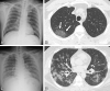Representative cases show pneumonia extents and patterns with chest
radiographs and CT images during the Delta period. (A, B) Images in a
54-year-old man 1 month after a first dose of BNT162b2 vaccine (partially
vaccinated) in the Delta period. The patient had no history of comorbidity.
(A) Chest radiograph obtained at admission shows no abnormality in both
lungs. The chest radiograph extent of pneumonia was scored as 0 (no evidence
of pneumonia). (B) Axial chest CT image obtained on the same day shows
unilateral focal ground-glass opacity in the right upper lobe (arrows). The
extent of pneumonia with CT was scored as 1 (1%–25% involvement), and
this case was classified as an "indeterminate" for COVID-19 pneumonia,
according to the RSNA chest CT classification system. (C, D) Images in a
32-year-old man with no history of COVID-19 vaccination and no history of
comorbidity in the Delta period. (C) Chest radiograph at admission shows
patchy ground-glass opacities in the middle to lower zones of both lungs.
The chest radiograph extent of pneumonia was scored as 2 (>25%
involvement). (D) Axial chest CT image obtained on the same day shows
multifocal ground-glass opacities with a crazy-paving appearance in
bilateral lungs. The extent of pneumonia with CT was scored as 2
(>25% involvement), and this case was classified as "typical" for
COVID-19 pneumonia, as per the RSNA chest CT classification
system.