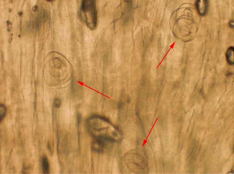 The figure above is a microscopic image of Trichinella spiralis encysted within implicated raw pork, in California in 2017.