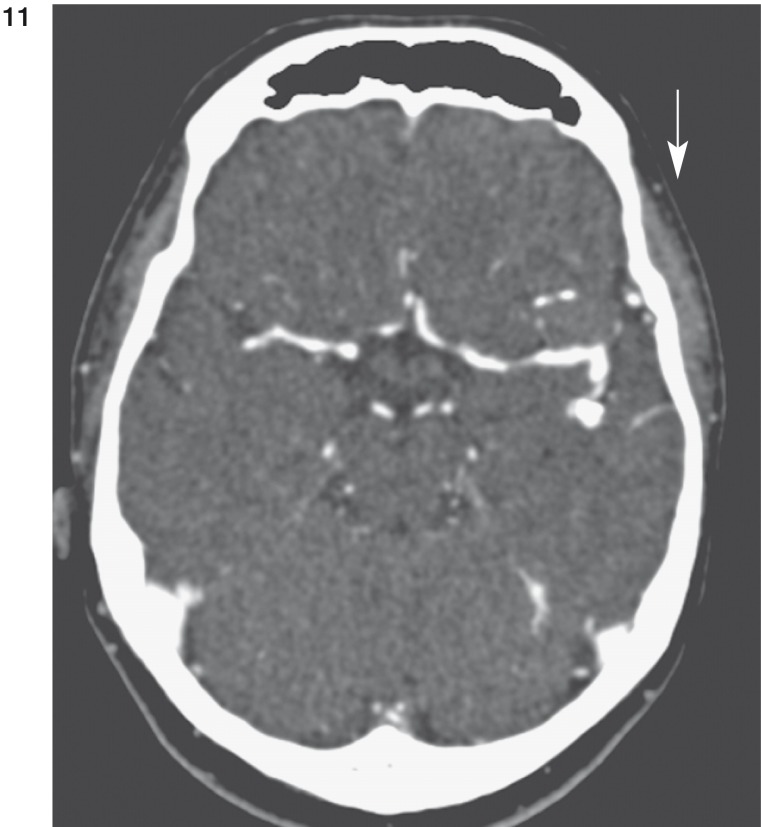 Figure 11 und 12