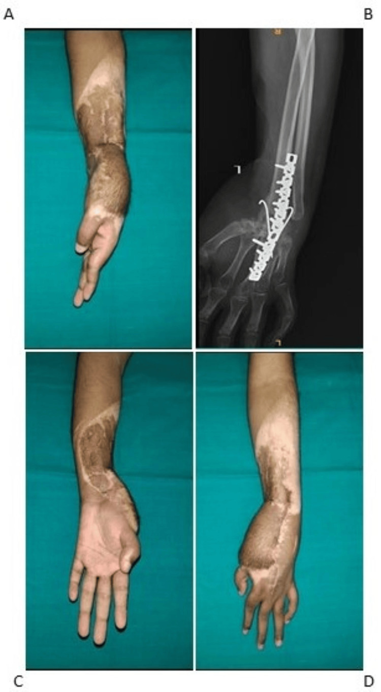 Management of Patients With Post-Traumatic Wrist Flexor Contracture by ...