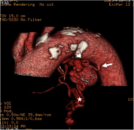 Fig. 1 An enhanced CT angiogram revealed a round, fusiform BAA adjacent to the distal aortic arch. This aneurysm had two inflow arteries, one is the left bronchial artery (arrow) and the other is a tortuous and thin artery branching from the lesser curvature of the aortic arch (arrowhead). Some indented outflow vessels drained to the pulmonary artery (asterisk).