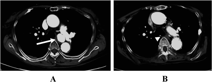 Fig. 2 (A) Preoperative axial CT image showed round mediastinal BAA (arrow). (B) Follow-up CT performed two years after treatment revealed no endoleak, and the size of the aneurysm was reduced to 8 mm (arrowhead).