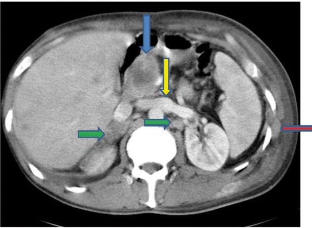 Figure 1F