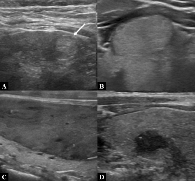 Tips for improving consistency of thyroid nodule interpretation with ...