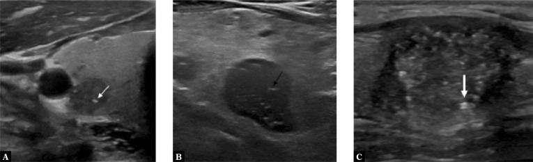 Tips for improving consistency of thyroid nodule interpretation with ...