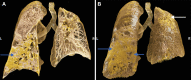 (A) Cinematic rendering of a chest CT image in a 60-year-old man who presented with real-time polymerase chain reaction–positive. SARS-CoV-2 pneumonia shows a coronal cross-section with consolidation in the left lower lobe (arrow). (B) Coronal shaded-surface display after cinematic rendering of image in the same patient, transitioning from denser tissue structures (collapse of pulmonary alveoli) (blue arrows) to less dense areas (transudate fluids) (white arrow).